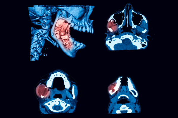 Knochentumore des Kiefers Computer Scan