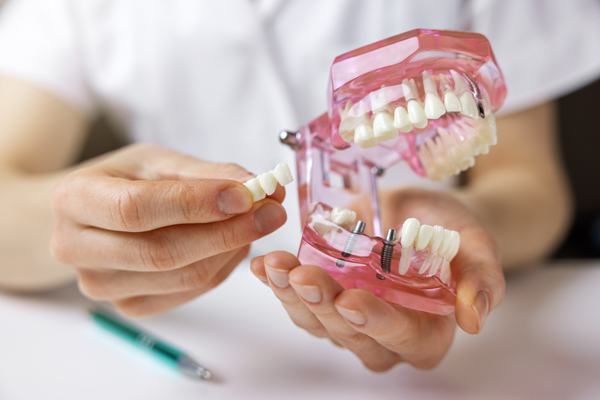 Kiefermodell mit Zahnimplantaten